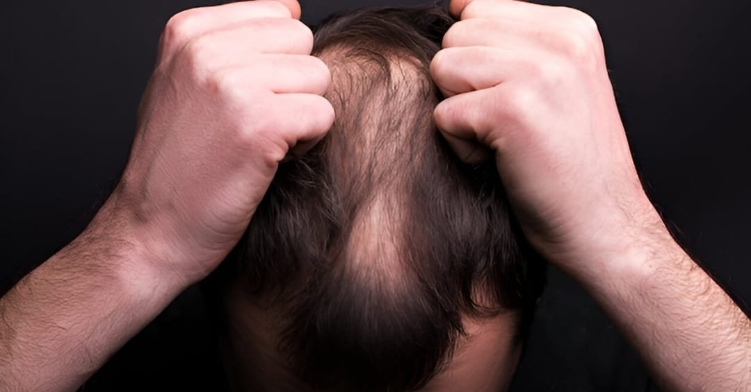 Jenis-Jenis Kebotakan dan Cara Mengatasinya Secara Medis